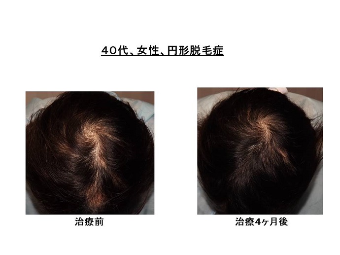 円形脱毛症　病院""